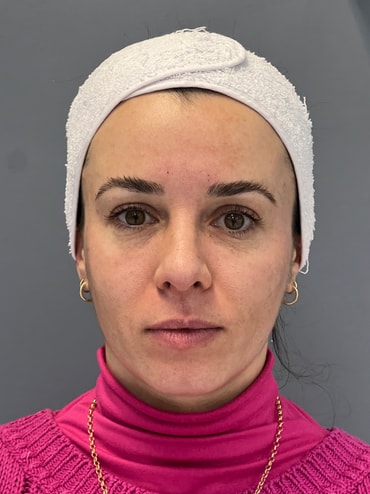 Fer depois do preenchimento de olheiras + bioestímulo de colágeno